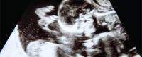 Ultrasound of twins
